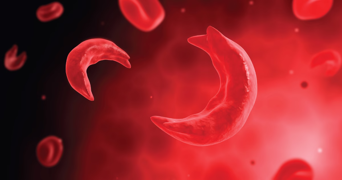 AIIMS Bhubneswar to lead as centre of excellence for sickle cell disease 1 AIIMS Bhubneswar