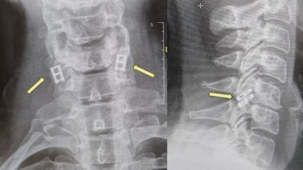 Spinal Cord Implant