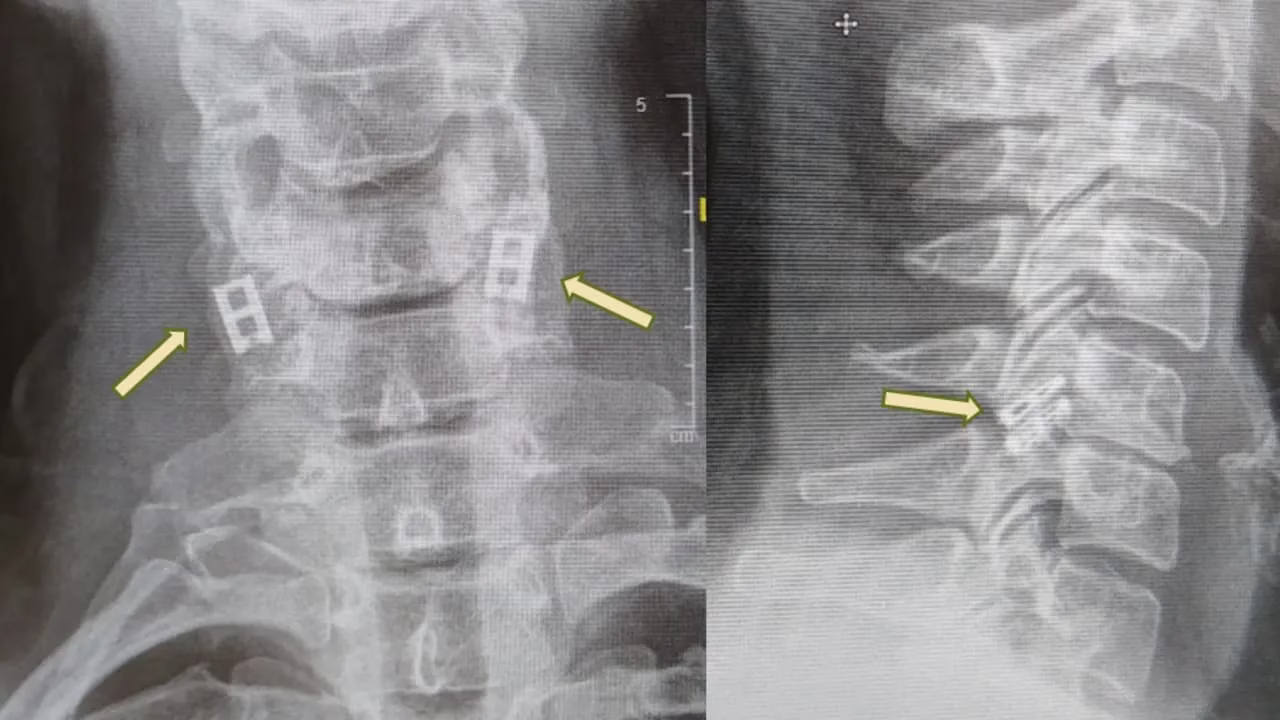 Spinal Cord Implant